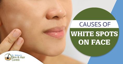 Causes of White Spots on Face #skintreatment, #skinproblems, #skincare, #acnetreatment, #laserhairremoval, #lasertreatment, #skindiseases, #scarremoval, #skin, #molesremoval, #birthmarkremoval, #dermatologist How To Remove White Spots On Face, How To Get Rid Of White Patches On Face, White Patches On Face, White Spots On Face, White Patches On Skin, White Spots On Skin, White Skin Patches, White Skin Spots, Skin Patches