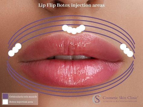 Everything you need to know about Lip Flip with Botox - The Cosmetic Skin Clinic Botox Lip Flip, Botox Injection Sites, Lip Flip, Botox Before And After, Botox Lips, Anti Wrinkle Injections, Aesthetic Doctor, Lower Lip, Botox Injections