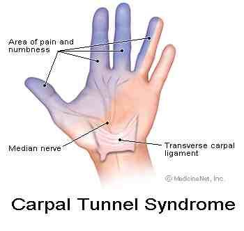 HELP !!! I am experiencing numbness, tingling, and burning in my arms. This has been going on since about September 2010. Last night was the worst. I Wrist Strengthening, Carpel Tunnel, Wrist Exercises, Median Nerve, Spinal Nerve, Spine Health, Tennis Elbow, Hand Therapy, Joints Pain Relief