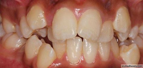 We all know that mouth conditions, such as crowding, spacing, overbite, overjet, crossbite, open bite, could cause a negative self-perception. Crowding Teeth, Dental Care, Conditioner, Pasta