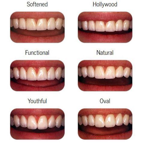 Cosmetic Dentistry - Los Angeles Cosmetic Dentistry - Culver City Cosmetic Dentistry - Centurysmile.com Teeth Makeover, Dental Makeover, Cosmetic Dentistry Veneers, Toothy Smile, Cosmetic Dentistry Procedures, Dental Aesthetics, Teeth Whitening Homemade, Veneers Teeth, Beautiful Teeth