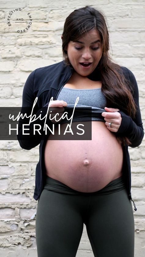 Hernias are caused by excessive pressure inside your abdomen and/or pelvis. While inguinal hernias are fairly common in men, umbilical hernias are the most common during pregnancy and postpartum. This is when part of your abdominal contents (fatty tissue and/or intestine) protrude through your navel/belly button. How To Fix A Herniated Belly Button, Belly Button Piercing After Pregnancy, Herniated Belly Button, Umbilical Hernias In Women, Pregnant Belly Button, Belly Support Band, Baby 2024, 3rd Trimester, Belly Support