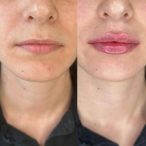 Lip Filler Before and After Lip Filler Swelling Day By Day, Lip Shapes Filler, Lip Filler Natural Look, Natural Lip Fillers Before And After, Natural Lip Fillers 0.5ml, Lip Fillers Before And After, 1 Ml Lip Filler Before And After, Lip Filler On Small Lips, Fillers Before And After