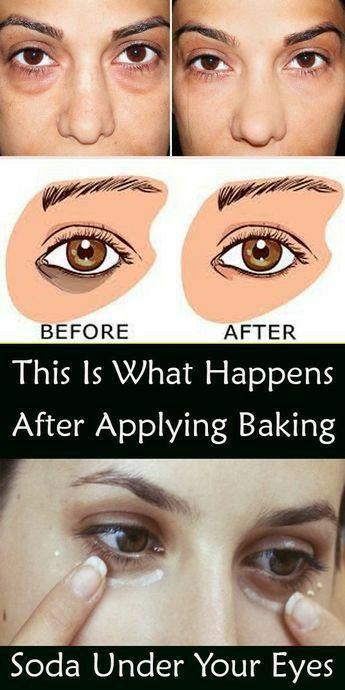 Baking Soda Under Eyes, Baggy Eyes, Hooded Eyelids, Baking Soda And Lemon, Teeth Whitener, Eye Natural, Dark Eye Circles, Remove Dark Circles, Skin Care Wrinkles