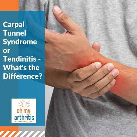 Carpal Tunnel Syndrome (CTS) and Wrist Tendinitis are caused by similar activities and share similar symptoms. Learn about the causes and symptoms and how to treat Carpal Tunnel and Tendinitis Carpel Tunnel Symptoms, Carpal Tunnel Symptoms, Sprained Wrist, Beauty Without Makeup, Median Nerve, Trigger Finger, Wrist Pain, Wrist Brace, Hand Pain