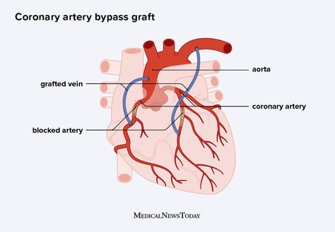 Nursing Study Tips, Heart Surgeon, Nurse Inspiration, Open Heart Surgery, Types Of Surgery, Bypass Surgery, Heart Muscle, Medical School Inspiration, Nursing School Tips