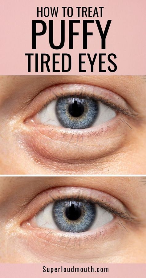 Eye Bag Remedies, Get Rid Of Eye Bags, Rid Of Eye Bags, Puffy Eyes Remedy, Baggy Eyes, Swollen Eyes, Skin Care Wrinkles, Under Eye Bags, Beauty Remedies