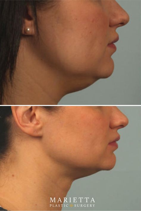 Getting rid of a double chin can be difficult. Kybella is an FDA-approved injectable drug that has been specifically designed to get rid of fat underneath the chin (submental fat) to give a sleeker and more defined appearance. When injected into the area underneath the chin, Kybella latches onto and destroys the fat cells in the area. Once destroyed, the fat cells are removed by the body’s natural processes. Fix Double Chin, Double Chin Lipo Before And After, Chin Injection Before And After, How Lose Face Fat Double Chin, Chin Filler Injection, Double Chin Reduction, Double Chin Removal, Clean Blackheads, Holiday Makeup Looks