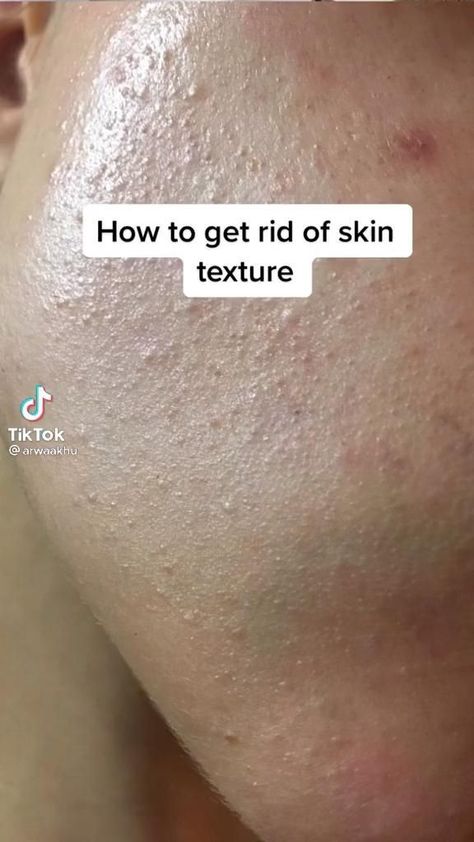 Haut Routine, Textured Skin, Bumpy Skin, Vegetarian Keto, Beauty Tips For Glowing Skin, Clear Skin Tips, Healthy Skin Tips, Facial Skin Care Routine, Skin Care Routine Steps