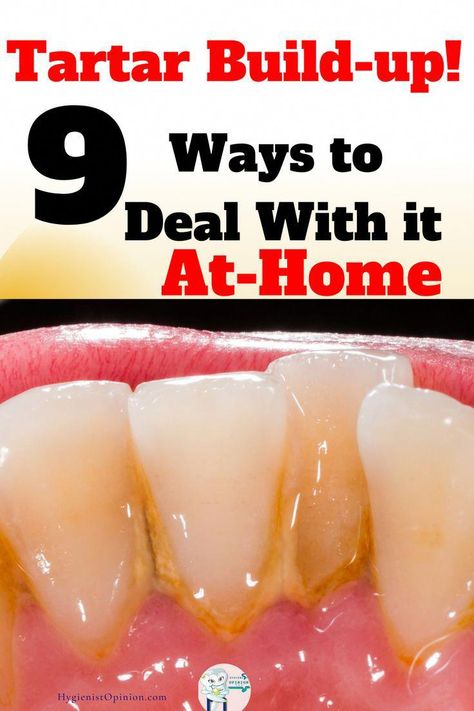 9 Ways to Deal With Tartar At Home. Plus Easy tips to try right now! Get Rid of Tartar and plaque fast! #WhatsOralCare Teeth Tartar Removal, Tartar Teeth, Tartar Removal, Tooth Decay Remedies, Teeth Health, The Teeth, Oral Care Routine, Gum Care, Receding Gums