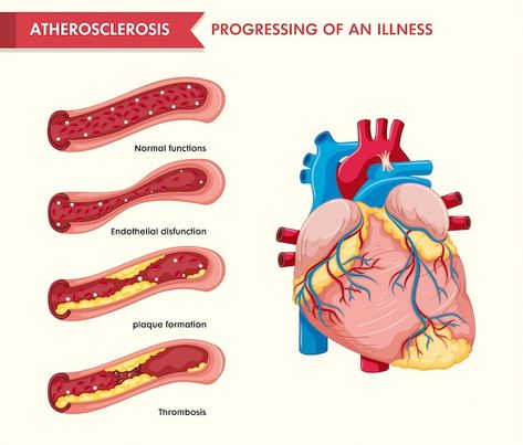 Aterosclerosi Vectors, Photos and PSD files | Free Download Face Pores, Bypass Surgery, Coronary Arteries, Heart Surgery, Natural Pain Relief, Good Doctor, Medical Illustration, Blood Flow, Surgery