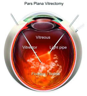 Vitrectomy Surgery, Eye Health Facts, Surgical Technologist, Surgery Center, Eye Exam, Scar Removal, Scar Tissue, Eye Health, Health Facts