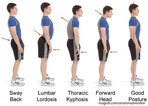 Bowen is beneficial for realignment and Posture Lumbar Lordosis, Posture Fix, Fitness Hacks, Forward Head Posture, Pelvic Tilt, Posture Exercises, Mobility Exercises, Bad Posture, Poor Posture