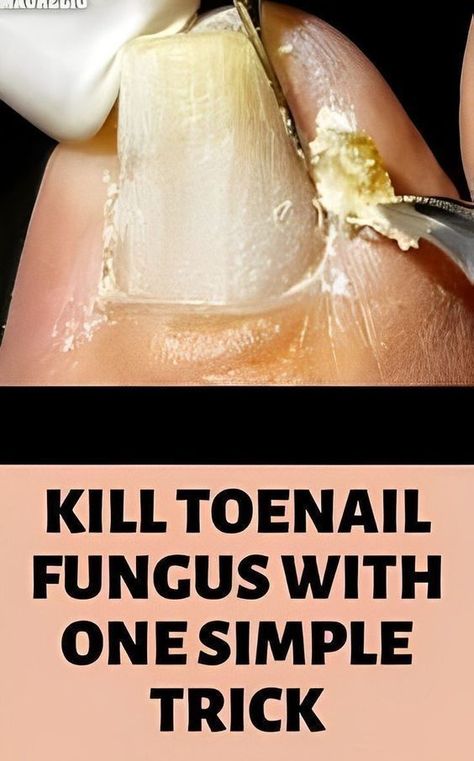 nail infection remedy Nails Remedies, Infected Toenail, Toenail Fungal Infection, Nail Remedies, Natural Antifungal, Nail Care Diy, Toenail Fungus Remedies, Nail Infection, Nail Fungus Remedy