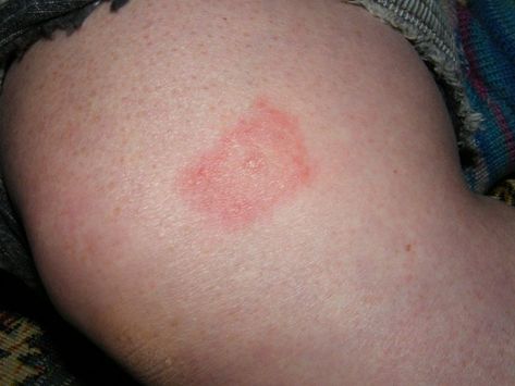 How to Identify the 10 Most Common Bug Bites in North America Spider Bites Pictures, Ant Bites, Wasp Stings, Tick Bite, Spider Bites, Mosquito Bite, Bug Bites, Peeling Skin, Insect Bites