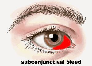 Subconjunctival Hemorrhage - The Eye Center How To Make Your Eyes Bloodshot Red, Home Remedy For Eye Infection, Subdural Hemorrhage, Eye Infestation Pressure, Blood Vessel In Eye, Eye Care Center, Washington Dc Metro, Eye Center, Physician Assistant