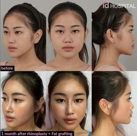 Asian Rhinoplasty Before After, Asian Nose Job, Rhinoplasty Asian, Korean Nose Job, Korean Nose, Jaw Reduction Surgery, Rhinoplasty Recovery, Nose Surgery Rhinoplasty, Nose Fillers