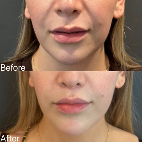 I had the absolute pleasure of seeing this beautiful bride-to-be for her 2 month follow-up. 👰‍♀️ We did a subtle upper lip lift to balance out her facial features and reveal more of her natural volume. The scar is a little pink as expected in this stage of healing, and will keep improving over the next few months. We are so excited for her next big chapter! #liplift #subnasalliplift #upperliplift Upper Lip Lift, Lip Lift, Upper Lip, Facial Features, Beautiful Bride, So Excited, The Next, Facial, Lips