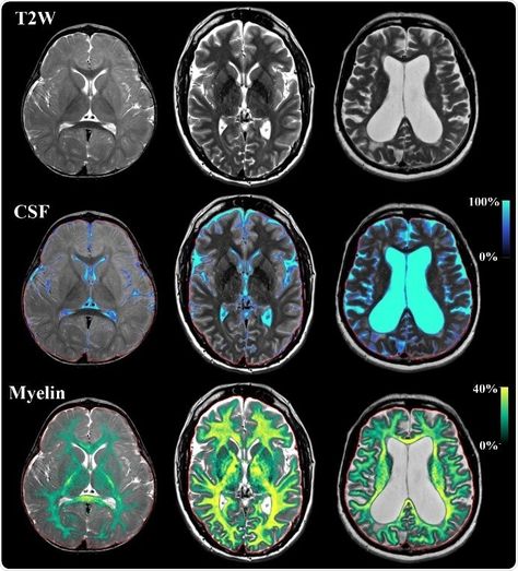 SyMRI approach provides myelin maps in scan times of only 5 minutes Arte Ganesha, Space Whale, Brain Images, Brain Scan, Med School Motivation, Brain Art, Medical School Motivation, Medical Anatomy, Neurology