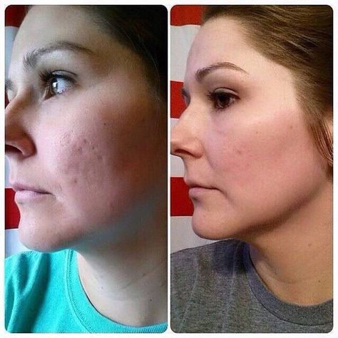 Have acne scars or any scars for that matter? R+F has something for that! Clinically proven skincare that actually gives real results when used consistently. Check out Barbie Porter's awesome before and after pic! She started with UNBLEMISH for a few months and recently started incorporating the MIcro-dermabrasion Paste & AMP MD Roller with the Night Renewing Serum! These are incredible results! Her skin looks amazing! Love these products! Before And After Acne, Best Acne Scar Removal, Amp Md Roller, Acne Scar Mask, Acne Scaring, Microdermabrasion Paste, Microdermabrasion Facial, Severe Acne, Types Of Acne