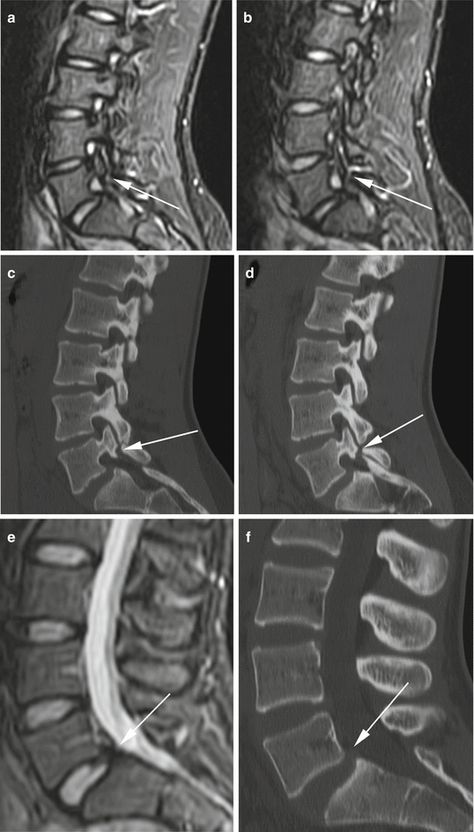 Imaging of Ballet Dancers’ Injuries | Radiology Key Ballet Injuries, Osgood Schlatter Disease, Meniscal Tear, Muscle Belly, Iliotibial Band, Ballet Body, Anterior Cruciate Ligament, Referred Pain, Cruciate Ligament