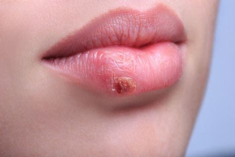 Heal A Cold Sore (Fever Blister) Faster - Simply and Naturally Fever Blister Remedy, Blister On Lip, Canker Sore Remedy, Home Remedies For Fever, Dark Circle Remedies, Get Rid Of Cold, Fever Blister, Canker Sore, Cold Sores Remedies