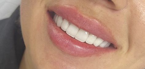 Perfect Smile Teeth Porcelain Veneers, Pretty Teeth Smile, Straight Teeth Smile, Straight Teeth Aesthetic, Perfect Smile Aesthetic, Beautiful Teeth Smile, Bunny Teeth Smile, Natural Fangs Teeth, Perfect Teeth Aesthetic