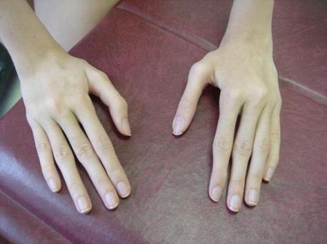 Arachnodactyly or “spider fingers”, is a condition in which the fingers are abnormally long and slender in comparison to the palm of the hand. Steven Universe Crossover, Human Oddities, Rare Disease, The Hand, The Palm, Graphic Image, Some Pictures, Medical, Human Body