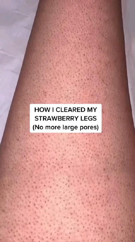 Haut Routine, Strawberry Legs, Beauty Tips For Glowing Skin, Healthy Skin Tips, Large Pores, Unwanted Hair Removal, Body Care Routine, Body Skin Care Routine, Healthy Skin Care