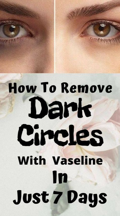 Dark Circles Around Eyes, Dark Circle Remedies, Dark Eye Circles, Skin Care Wrinkles, Dark Circles Under Eyes, Remove Dark Circles, Dark Under Eye, Eye Circles, Dark Eyes