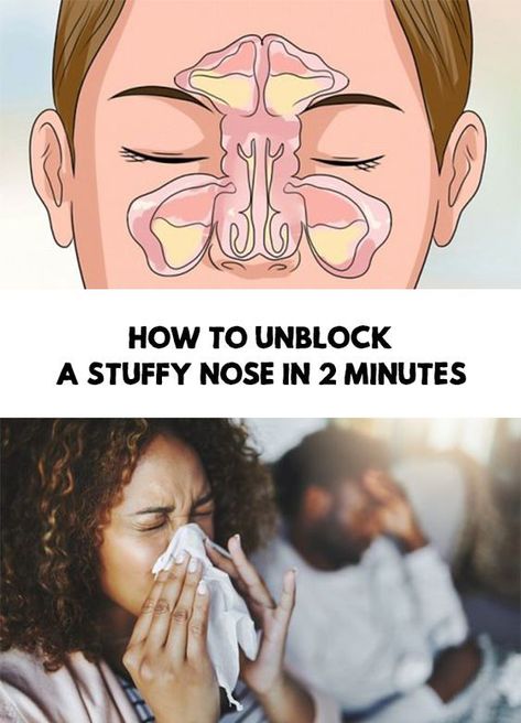 Stuff Nose Remedies, How To Unblock Nose, Nasal Congestion Relief, Congestion Remedies, Stuffy Nose Remedy, Blocked Nose, Nasal Decongestant, Chest Congestion, Nasal Passages