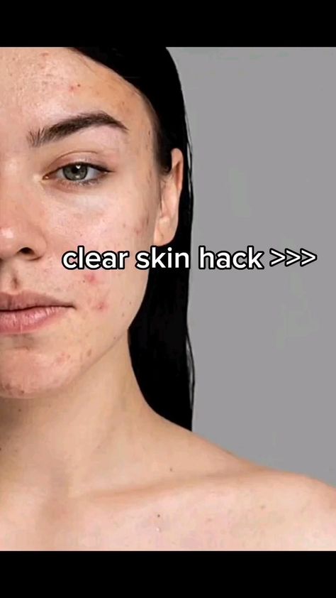 CLEAR SKIN HACK>>> Clear Skin Face Mask, Best Skincare Routine, Face Skin Care Routine, Clear Skin Face, Skincare Secrets, Skin Face Mask, Skin Care Routine Order, Diy Skin Care Routine, Natural Face Skin Care