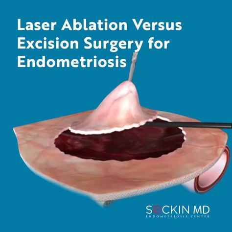 Did you talk to your doctor about the different #endometriosis surgery techniques? Did you know about #excision or #ablation? Tell us by leaving a comment. Read More: https://drseckin.com/laser-ablation-versus-excision-surgery-for-endometriosis/ Pelvic Pain, Talking To You, Surgery, Did You Know, Read More