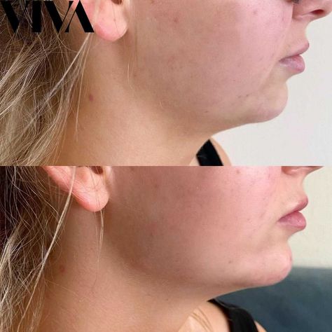 Jawline Enhancement is a fantastic way to bring strength and character to the jaw, where this may appear naturally weak. Jawline fillers last 9-18 months. Weak Jawline, Jawline Filler, Ear Cuff, Stud Earrings