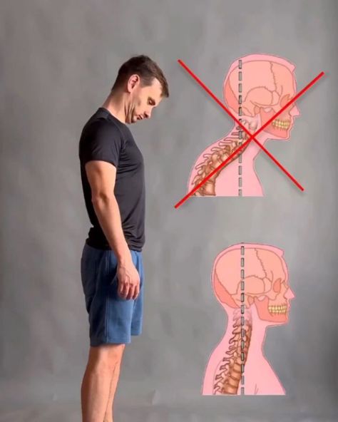 Learn Calisthenics | Get rid of the neck hump & upper back issues! MUST READ & SAVE ⚠️ By @makarin Neck hump is a visible bump at the back of your neck that… | Instagram How To Reverse Neck Hump, How To Remove Neck Hump, Reduce Neck Hump, How To Reduce Back Neck Hump Women, How To Remove Back Neck Hump, Learn Calisthenics, Neck Hump, Mobility Training, Blood Circulation