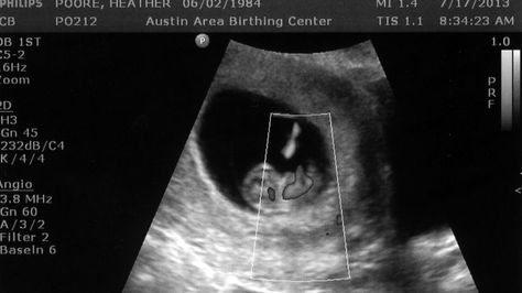 The Dating Ultrasound at 9 weeks to determine the due date of the baby 9 Week Ultrasound, Baby Ultrasound, Birth Center, Due Date, Ultrasound, Baby Photos