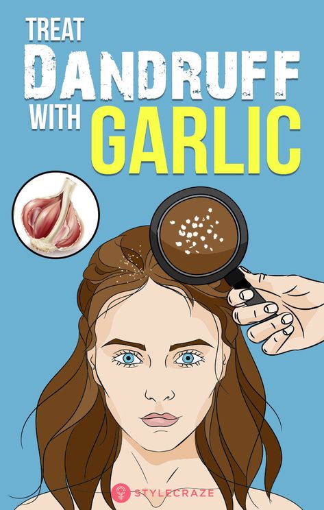 How Does Garlic Help Control Dandruff: Garlic is believed to be an excellent herbal remedy to get rid of this skin condition because of its high vitamin and mineral content. Benefits of garlic are enjoyed either by direct consumption in regular diet to help provide vital nutrients to the skin and scalp or as extracts present in shampoos, soaps, oils and medicinal capsules which are specifically formulated and used to treat dandruff. #Hair #HairCare #Dandruff #Remedies Garlic Benefits, Getting Rid Of Dandruff, Healthy Hair Tips, Itchy Scalp, Utila, Hair Breakage, Washing Hair, Strong Hair, Hair Care Routine