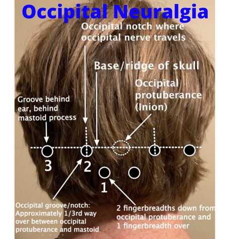 Occipital Nerve Block, Complex Migraine, Forward Head Posture Exercises, Occipital Neuralgia, Neck And Shoulder Muscles, Migraine Prevention, Headache Types, Head Pain, Chronic Migraines