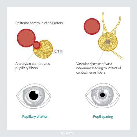 Pupil-Involved vs. Pupil-Sparing Acquired Oculomotor Nerve Palsy Oculomotor Nerve, Brain Surgeon, Cranial Nerves, Online Study, Vital Signs, Medical History, Primary Care, Renovation Ideas, Medical Conditions