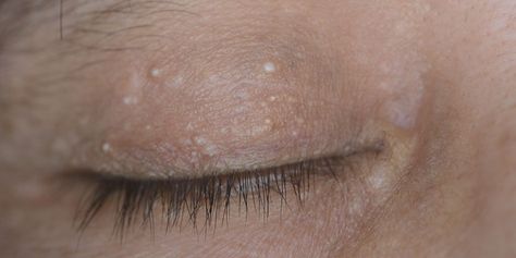 Bump On Eyelid, White Bump On Eyelid, White Bumps On Skin, Head Acne, Healthy Skin Care Routine, Laser Surgery, Eye Center, Upper Eyelid, Facial Peel