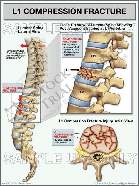 This trial exhibit depicts lumbar spine anatomy with L1 compression fracture of the vertebra, shown in the lateral view with a close up view of injury and injury is also shown in the axial view, with descriptive labels of anatomy and injuries. Spinal Compression, Spine Anatomy, Lumbar Spine, Spinal Injury, Accident Injury, Dry Skin Remedies, Body Pain, Medical Knowledge, Medical Information