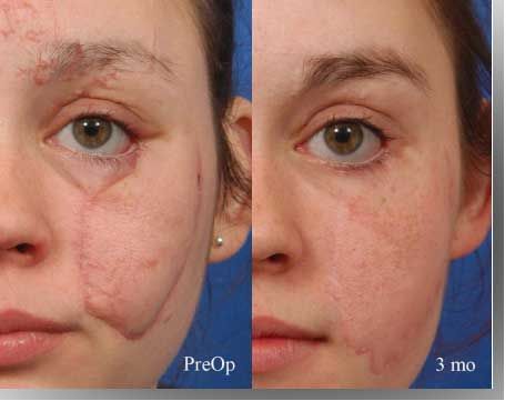 circular face scar- minimized by surgurey Scars On Dark Skin Reference, Scar Revision, Facial Warts, Lightning Scar, Hypertrophic Scars, Spfx Makeup, Plastic Surgery Gone Wrong, Facial Scars, Pimples Under The Skin