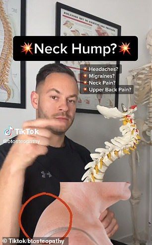 How To Correct Neck Hump, Hairstyles To Hide Neck Hump, Buffalo Hump Exercises, How To Fix Neck Hump, Neck Hump Get Rid Of, Exercises For Upper Back Pain, Exercises For Upper Back, Lower Back Pain Stretches, Neck And Shoulder Exercises