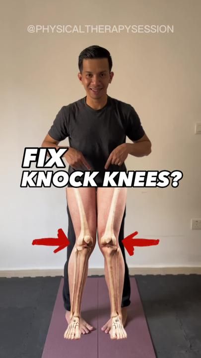 Fix Knock Knees, Knock Knees Exercises, Knee Pain Relief Exercises, Hyperbolic Stretching, Knock Knees, Gymnastics Stretches, Thighs Exercises, Quad Exercises, Easy Exercises