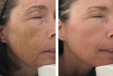 Fraxel Dual Laser - Serenity MedSpa Fraxel Laser Before And After, Fraxel Before And After, Fraxel Laser, Face Treatments, Laser Skin Resurfacing, Skin Resurfacing, Laser Skin, Med Spa, Reduce Wrinkles