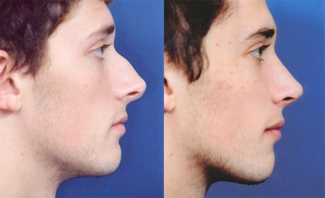 Rhinoplasty Men Nose Job Before And After, Men’s Nose Job, Mens Nose Job, Male Plastic Surgery Before After, Male Nose Reference, Men Nose Job, Men Rhinoplasty, Rhinoplasty Before After, Male Nose Job