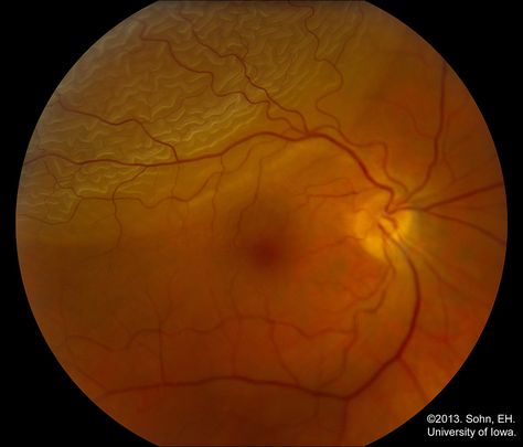 Bullous superotemporal rhegmatogenous retinal detachment of the right eye Retina Detachment, Posterior Vitreous Detachment, Eye Conditions, Eye Facts, One Medical, Birthday Posters, Vision Loss, Happy Birthday Posters, Vision Eye