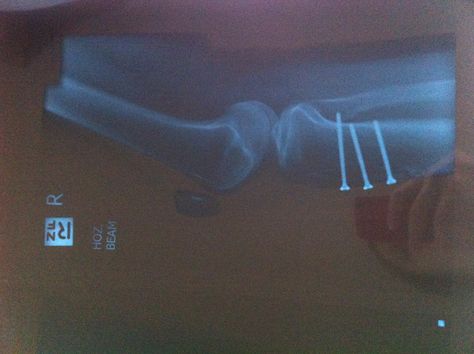 Tibial tubercle transfer X-ray. Surgery for dislocating knee caps. Knee Cap, Looking For Alaska, Knee Surgery, Bees Knees, X Ray, Surgery, Health, Quick Saves