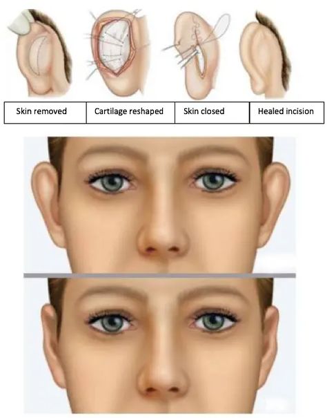 ear correction surgery in Lucknow Ear Pinning Surgery, Ear Structure, Facial Plastic, Ear Pins, The Patient, Medical Illustration, Cosmetic Surgery, Body Mods, First Step