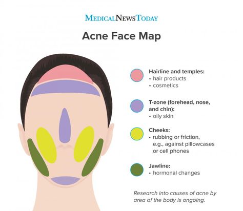 Acne face map: Causes of breakouts Doterra Acne, Acne Face Map, Face Map, Painful Pimple, Face Mapping Acne, Blind Pimple, Forehead Acne, Pimples Under The Skin, Bad Acne